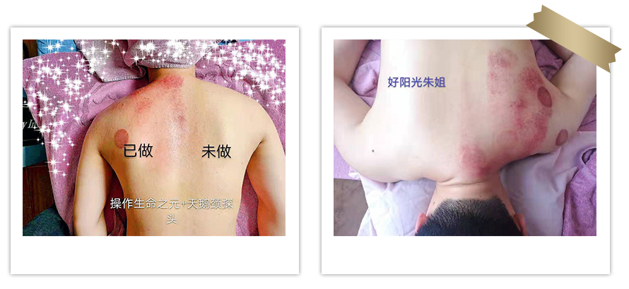 三椎暢活養(yǎng)護(hù)(圖3) 三椎暢活養(yǎng)護(hù)(圖3)